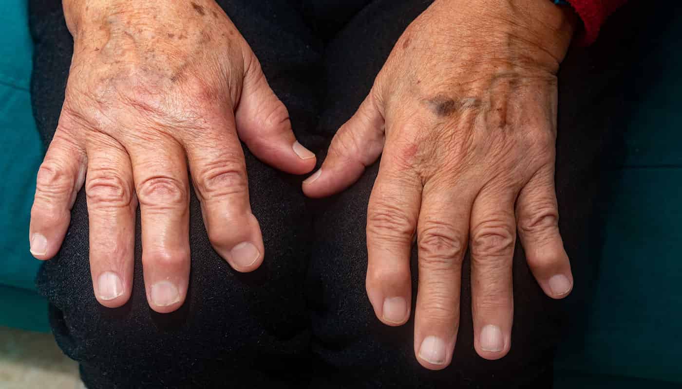 Articolazione della mano con artrosi