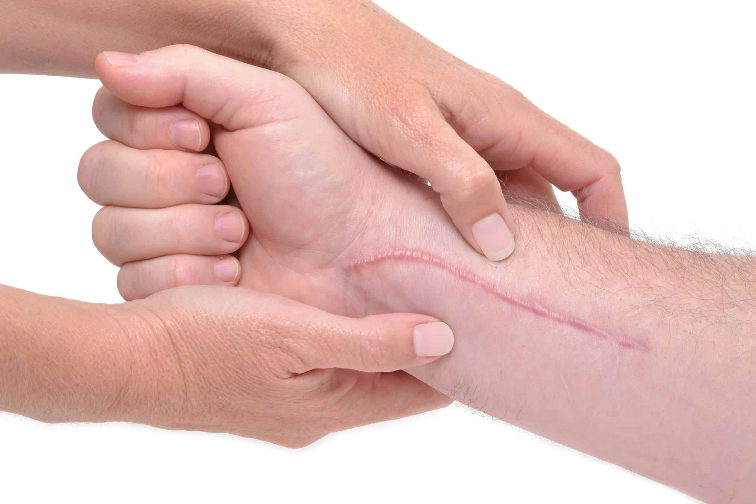 Lesione tendinea mano polso gomito