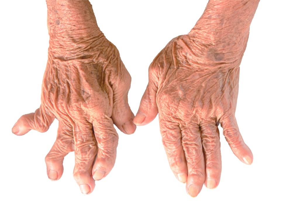 Illustrazione articolazione infiammata da Artrite Reumatoide