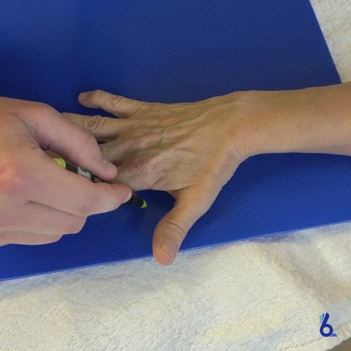 Tutore su misura in termoplastica indossato sulla mano, chiuso con i velcri
