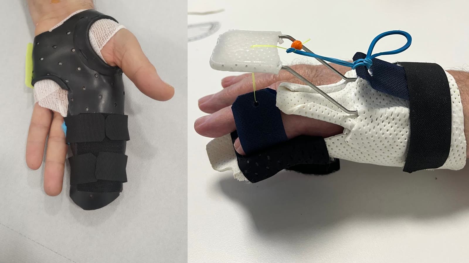 Due tutori per la mano dopo il trattamento del Dupuytren: uno scuro in estensione, visto dal palmo, e uno bianco con elastico e filo per le dita, visto di lato