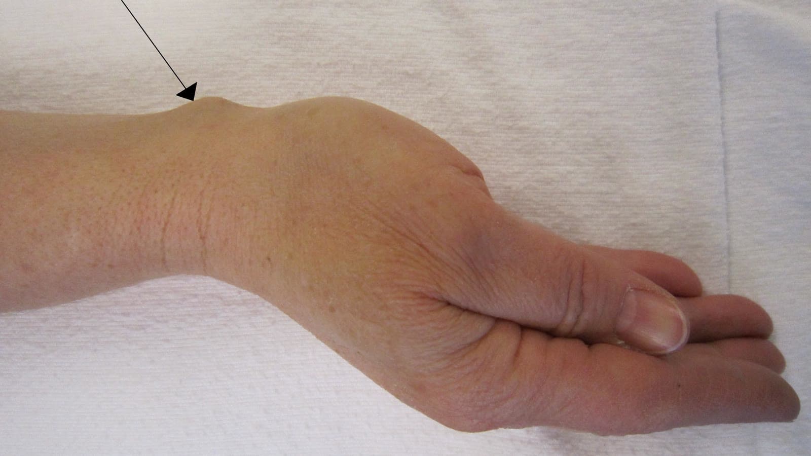 Polso visto di lato con un rigonfiamento sul dorso, un ganglio, indicato da una freccia