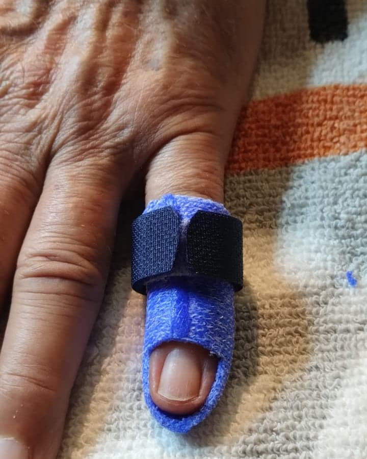 Dorso della mano con un tutore blu su misura chiuso con velcro sull’ultima falange
