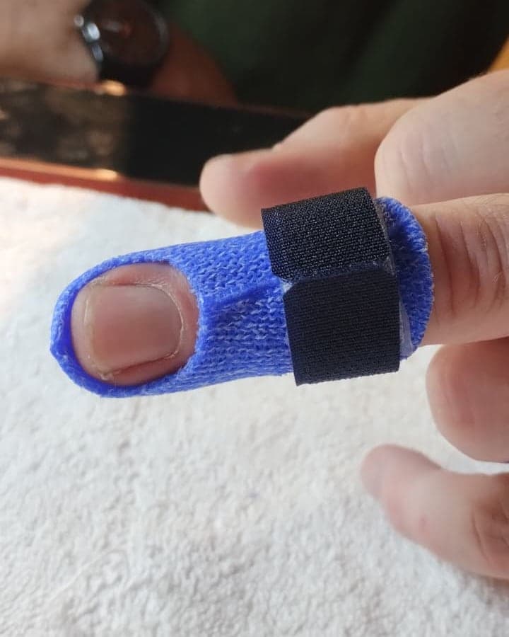 Dito con un tutore blu su misura chiuso con velcro, con l’unghia lasciata scoperta